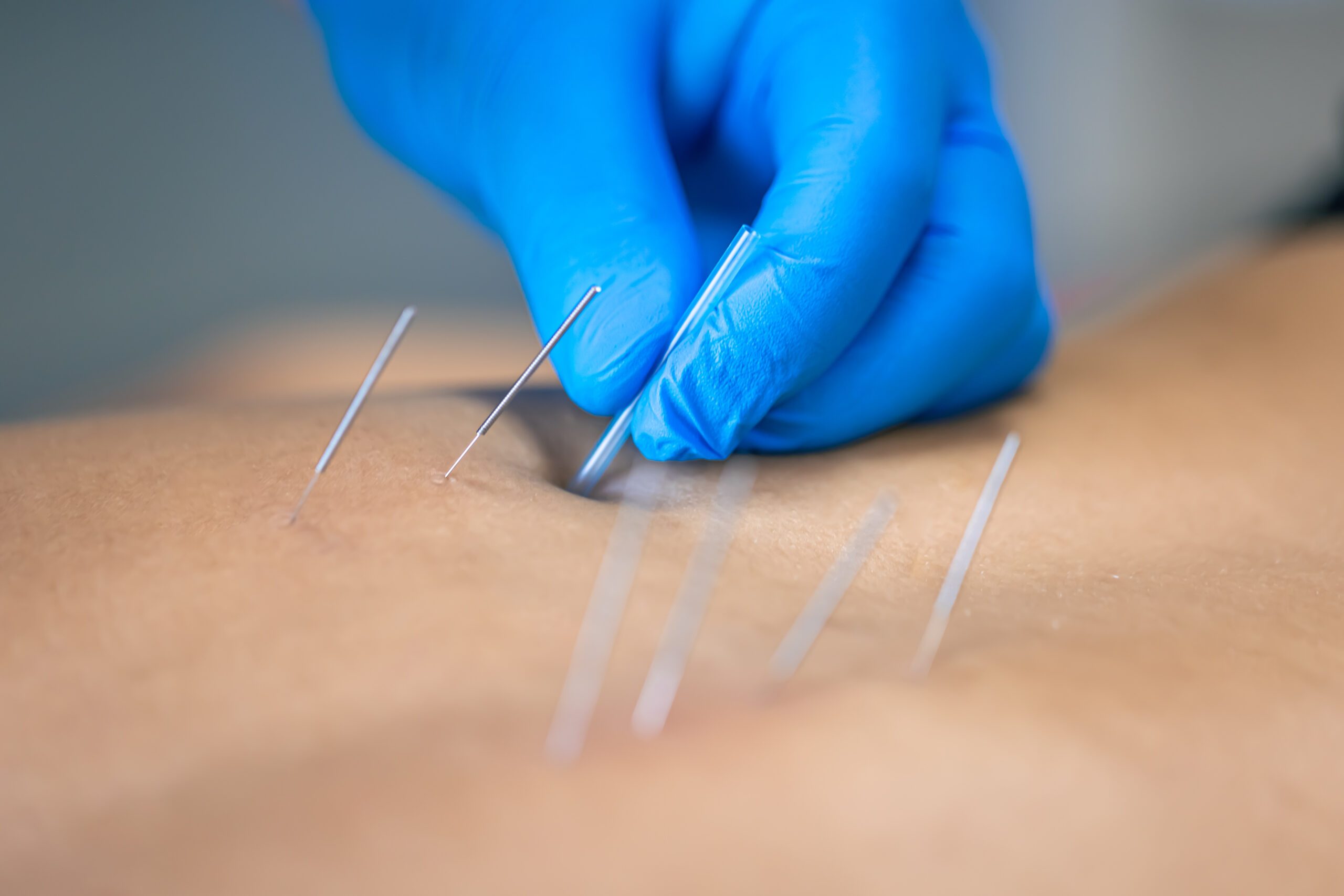 Difference between Dry Needling and Acupuncture